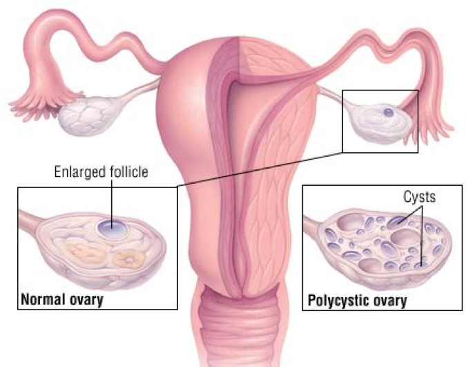 symptoms of pcod